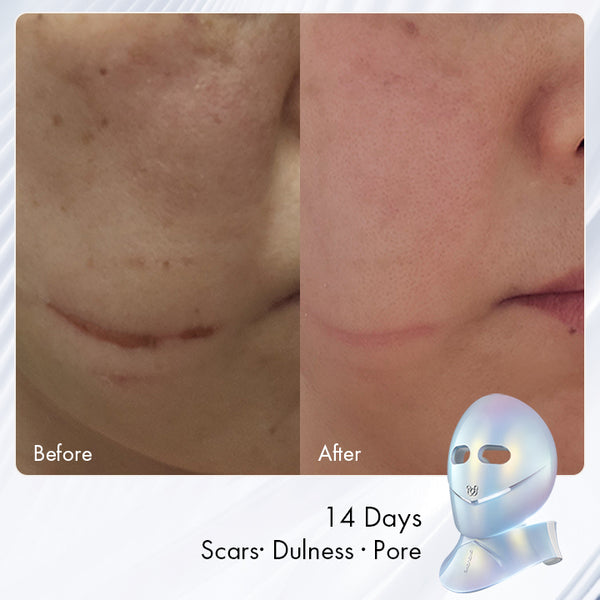 Chouohc Radiance LED Mask