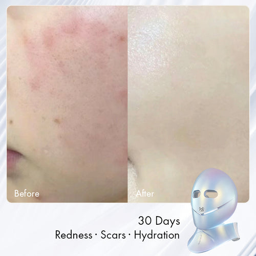 Chouohc Radiance LED Mask